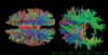 Diffusion Tensor Imaging (DTI)