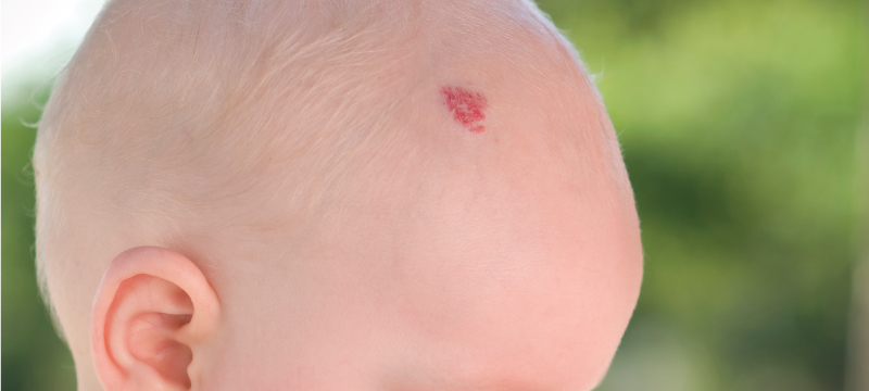 All About Birthmarks