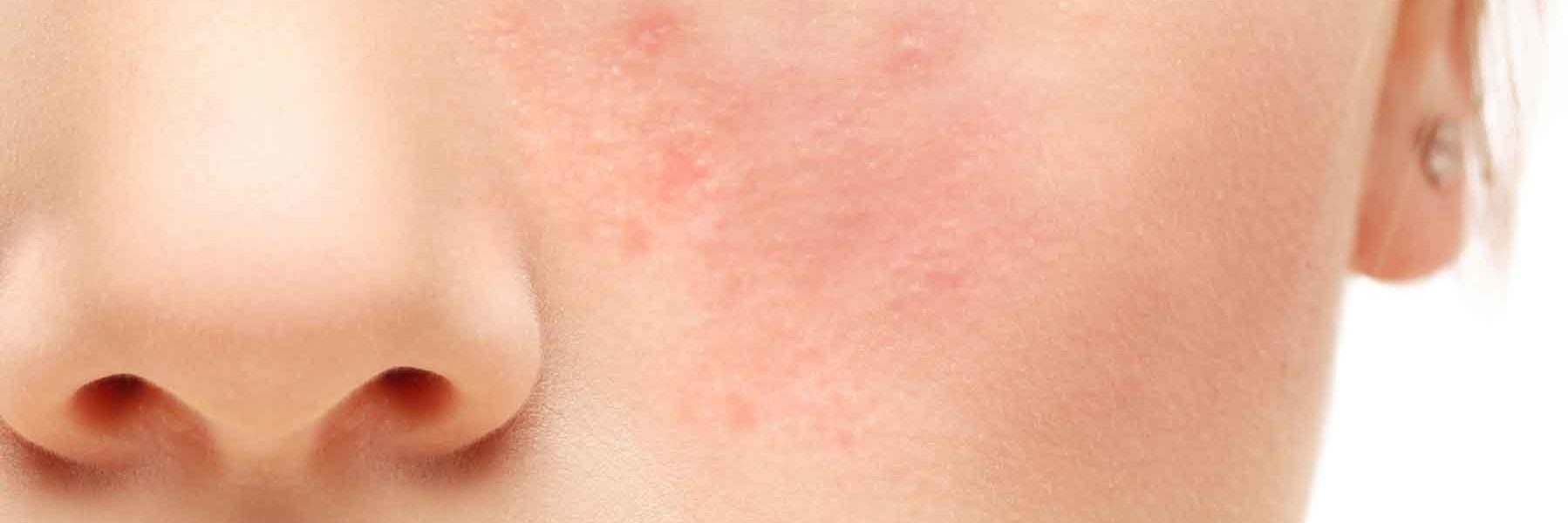 Rosacea: When the Acne Won't Go Away – Sather Health