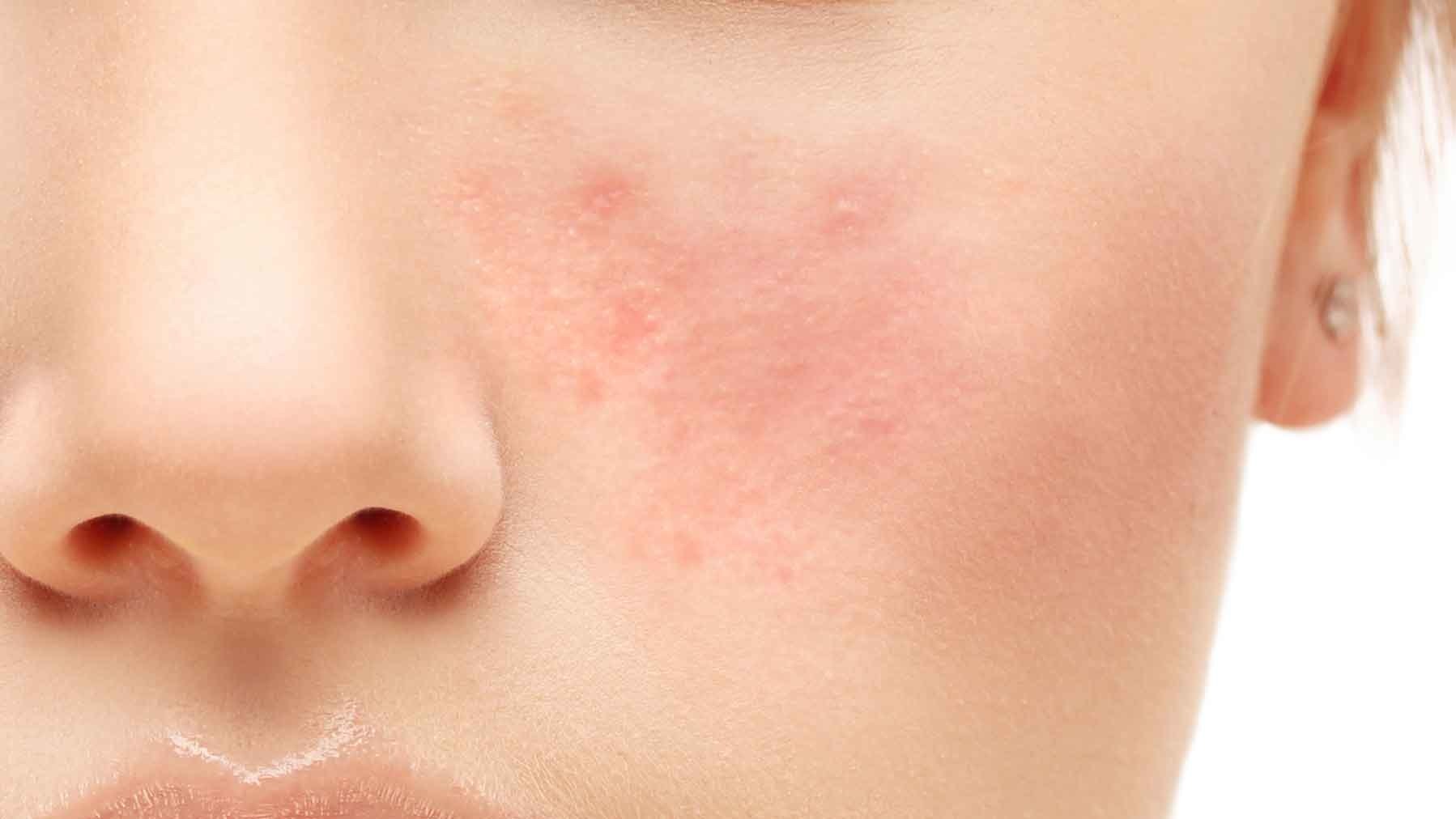 Rosacea: When the Acne Won’t Go Away